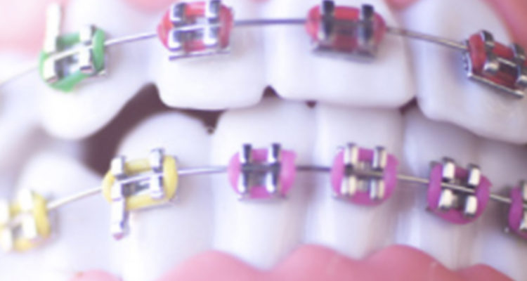 ortodonzia fissa